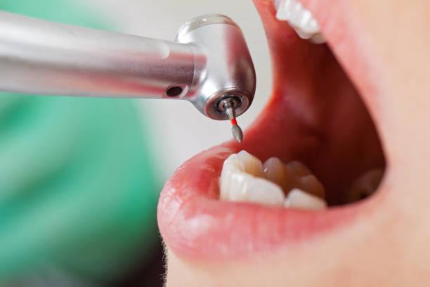 Best Emergency Dental Surgery in Quinlan, TX